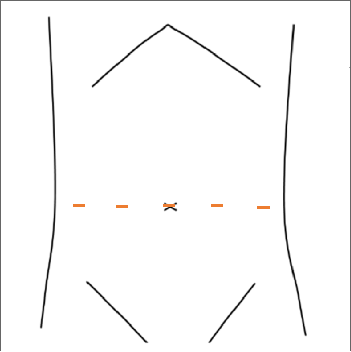 ダヴィンチ手術図解