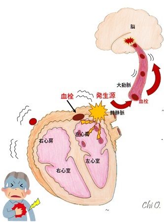 脳梗塞