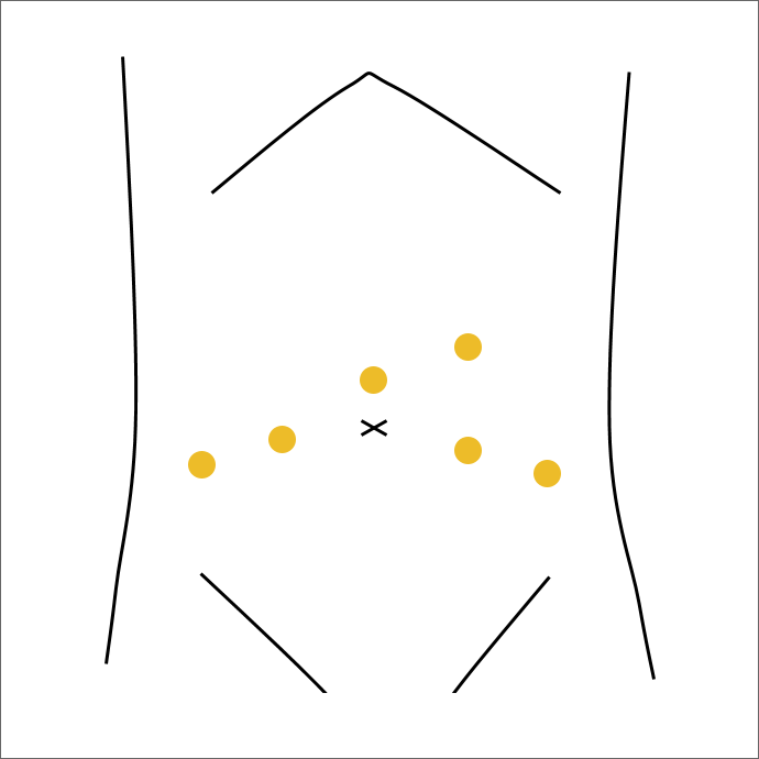 ダヴィンチ手術図解