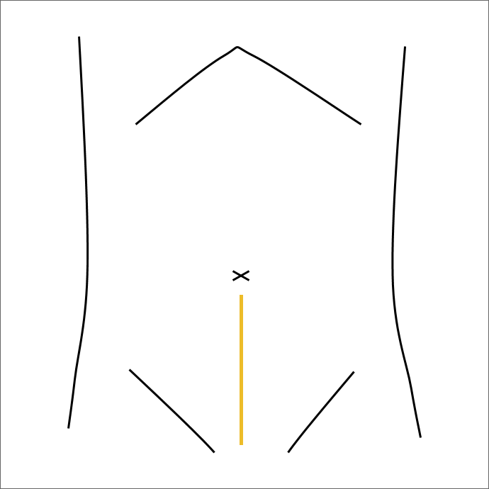 開腹手術図解